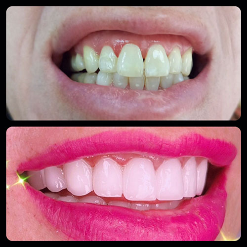 Model Teeth