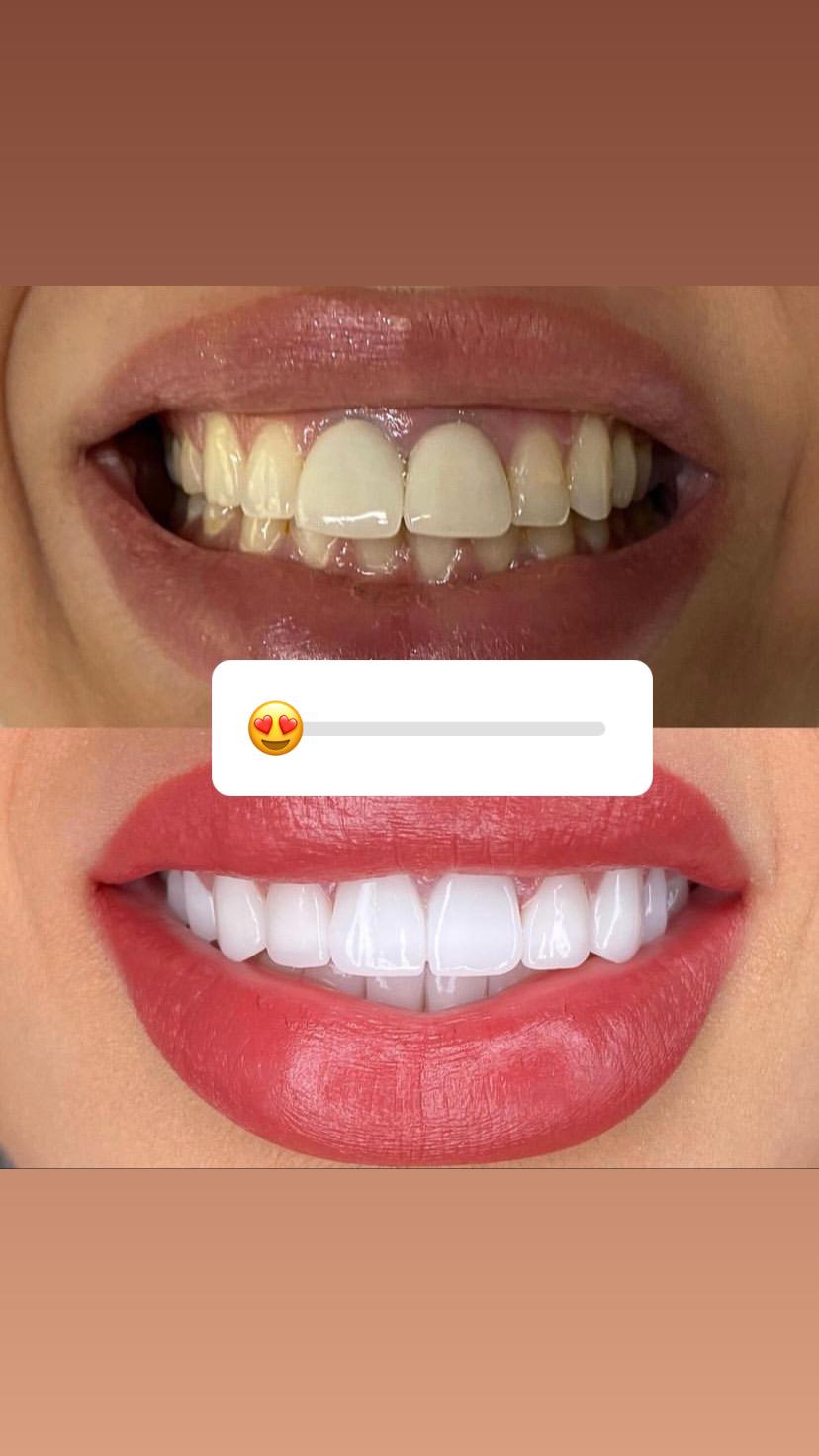 Model Teeth